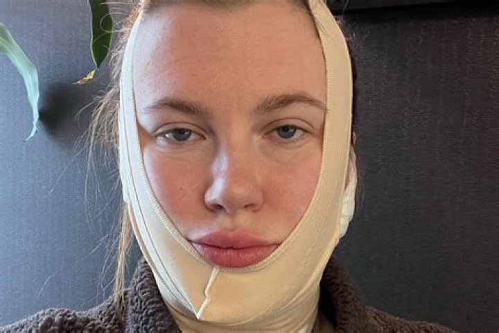 Ireland Baldwin Reveals Fully Bandaged Face After Getting ‘FaceTite’ With Cousin: Photos